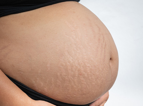 孕期怎么预防妊娠纹？什么可以淡化妊娠纹？
